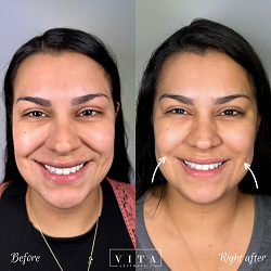 Woman face, eye wrinkles before and after treatment - the result of rejuvenating cosmetological procedures of biorevitalization, botox and pigment spots removal | Vita Aesthetics in Sarasota, FL