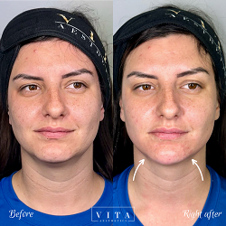 Woman face, eye wrinkles before and after treatment - the result of rejuvenating cosmetological procedures of biorevitalization, botox and pigment spots removal | Vita Aesthetics in Sarasota, FL