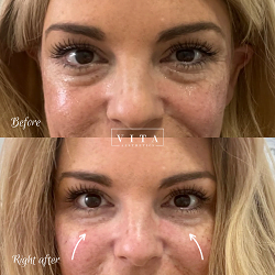 Woman face, eye wrinkles before and after treatment - the result of rejuvenating cosmetological procedures of biorevitalization, botox and pigment spots removal | Vita Aesthetics in Sarasota, FL