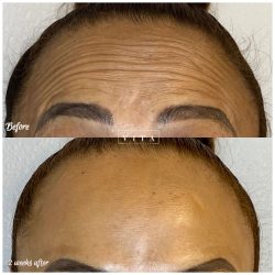 Woman face, eye wrinkles before and after treatment - the result of rejuvenating cosmetological procedures of biorevitalization, botox and pigment spots removal | Vita Aesthetics in Sarasota, FL