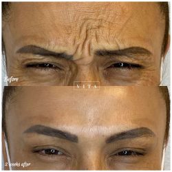 Woman face, eye wrinkles before and after treatment - the result of rejuvenating cosmetological procedures of biorevitalization, botox and pigment spots removal | Vita Aesthetics in Sarasota, FL