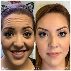 Woman face, eye wrinkles before and after treatment - the result of rejuvenating cosmetological procedures of biorevitalization, botox and pigment spots removal | Vita Aesthetics in Sarasota, FL