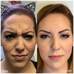 Woman face, eye wrinkles before and after treatment - the result of rejuvenating cosmetological procedures of biorevitalization, botox and pigment spots removal | Vita Aesthetics in Sarasota, FL