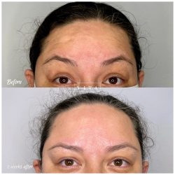 Woman face, eye wrinkles before and after treatment - the result of rejuvenating cosmetological procedures of biorevitalization, botox and pigment spots removal | Vita Aesthetics in Sarasota, FL